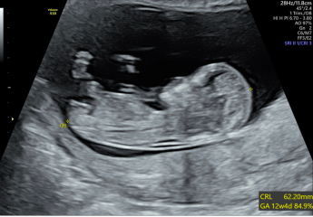 Over worrying about this pregnancy.