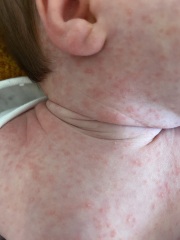 Baby acne or CMPA or something else??