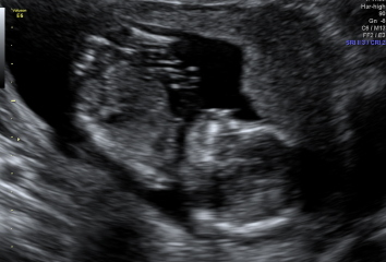 14 weeks, any nub?