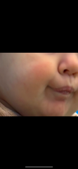Fifth disease or teething cheeks etc?