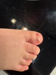 DD big toe