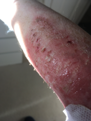Need help with really sore skin.
