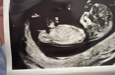 10 week scan, is this normal?