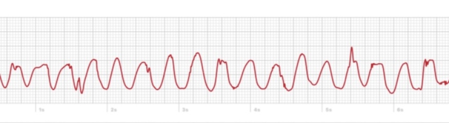 Apple Watch ECG help?