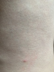 To think these are flea bites?