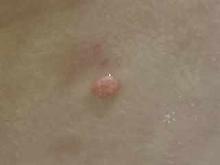 Any ideas what this could be - Molluscum contagiosum?
