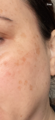 Monderma prescription for pigmentation