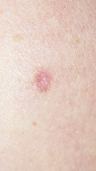 Could this be skin cancer?