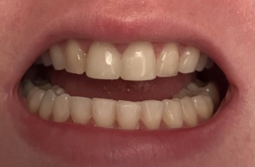 Not sure if I’m happy with Invisalign results…