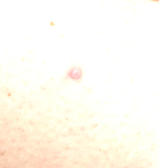 Skin spot - Has anyone had anything that looks like this?