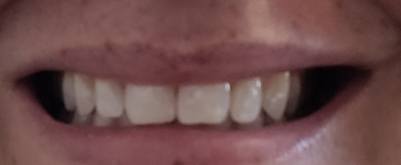 Pics of teeth - bonding or invisalign as well?