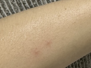 Help- do I have chicken pox??
