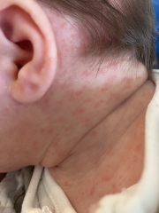 Is this baby acne or cmpa? Please help!