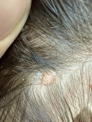 Weird looking mole on scalp