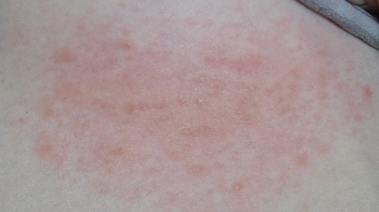 Is this shingles?!