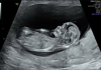 Over worrying about this pregnancy.