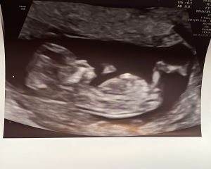 Nub theory guesses - boy or girl?