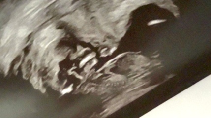Baby gender nub or skull theory