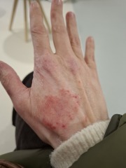 Hand infected (Warning, gross photos)