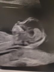 Ultrasound high chance for down syndrome. Please help