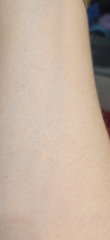 Rash and nausea