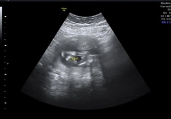 Gender scan at 15 week pics! ❤️
