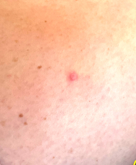 Skin spot - Has anyone had anything that looks like this?