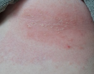 Is this shingles?!