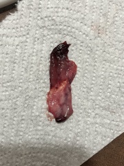 Decidual Cast from potential endometriosis? WARNING pictures