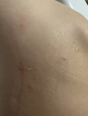 Help- do I have chicken pox??