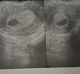 Can someone help me calculate my gestational sac size in mm?