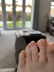 Swollen top of 2nd toe