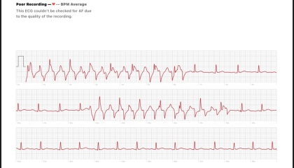 Apple Watch ECG help?