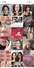 Why do people get massive amounts of lip filler?