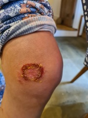 Ringworm  ?