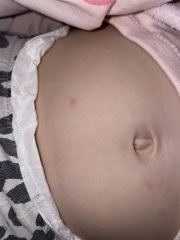 Rash and red behind ear -pox? Mastoiditis ?