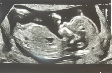 Boy or girl predictions from scan?