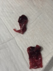 Is this a miscarriage or a blood clot?