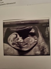 Going down a rabbit hole with nub theory (yes I know I am crazy) - Is this definitely a boy!