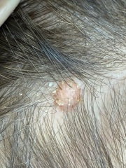 Weird looking mole on scalp