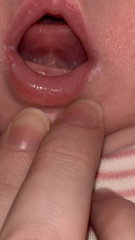 Tongue tie?