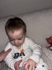 Head bump with lump and bruise