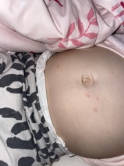 Rash and red behind ear -pox? Mastoiditis ?