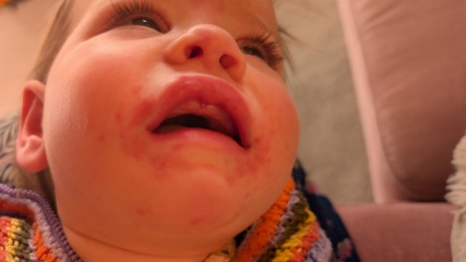 Can you help me identify this rash/spots?