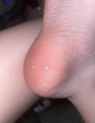 Anyone ever had verrucas?