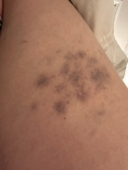 Unexplained Bruising?
