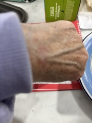 Melanoma