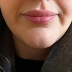 Facial puffiness/swelling  - photos included