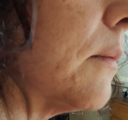 Am I a good facelift candidate?