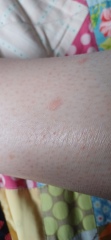Skin spot - Has anyone had anything that looks like this?